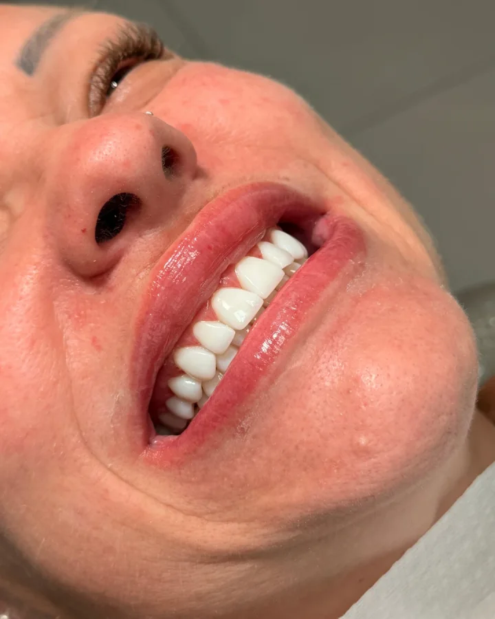 Sorriso com facetas, visto de baixo