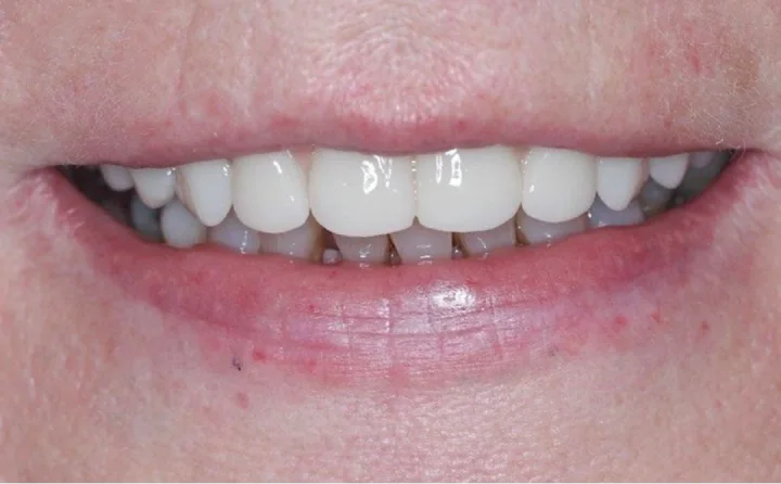 Sorriso com facetas, visto de frente
