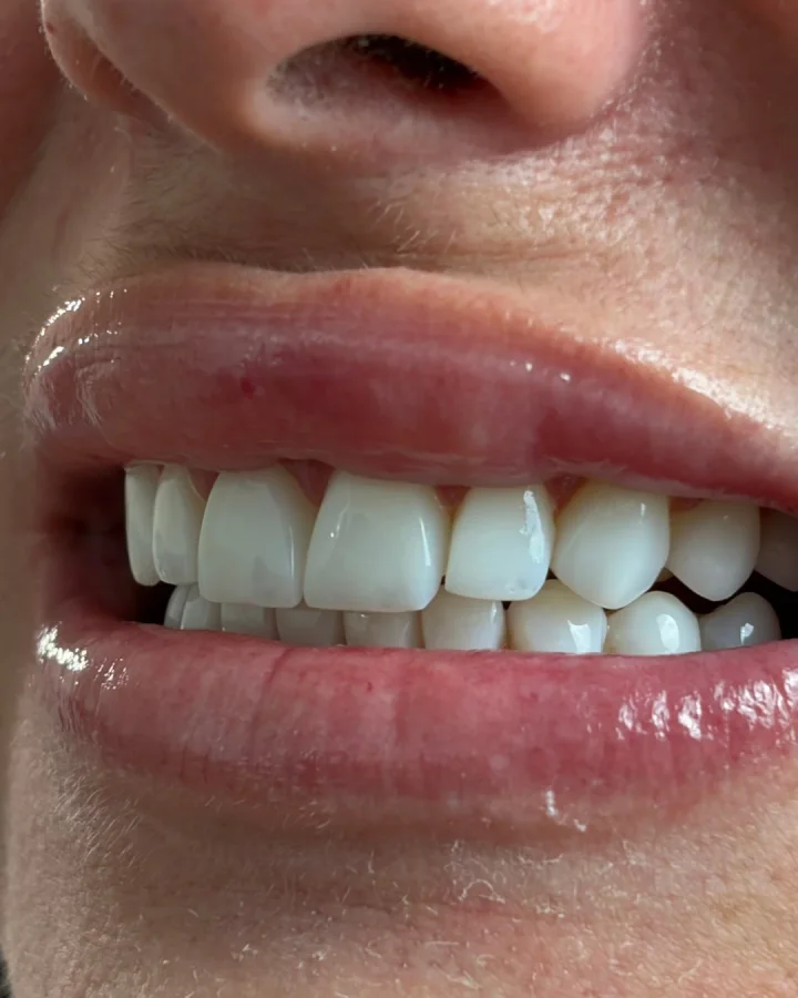 Sorriso com facetas, visto de perfil