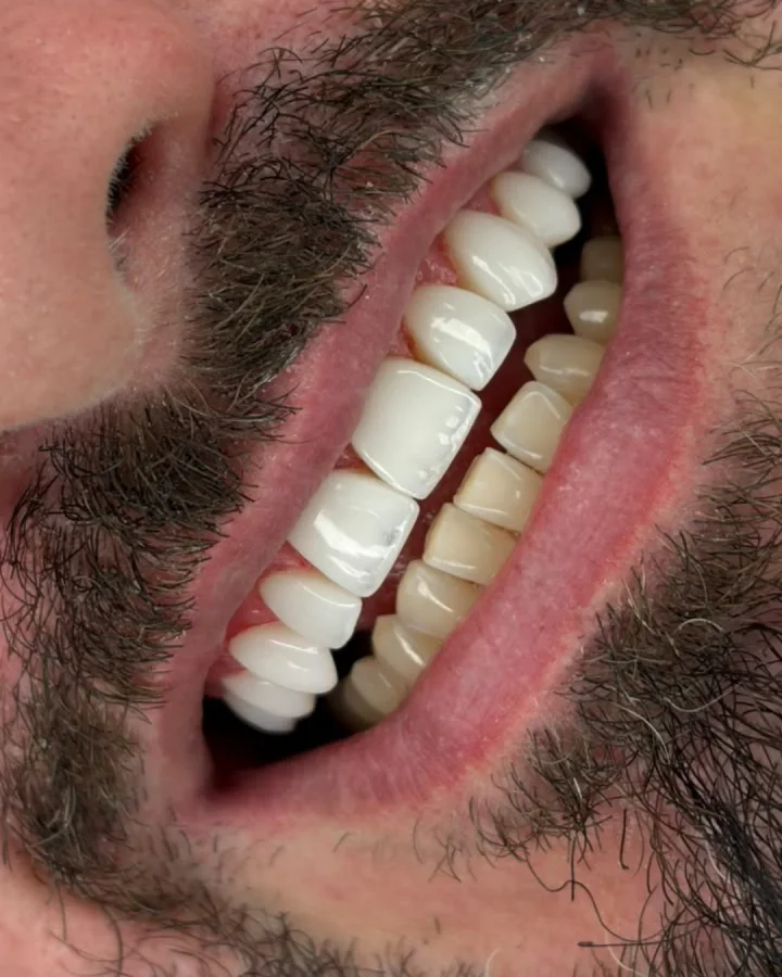 Paciente sorrindo após reabilitação dos dentes superiores