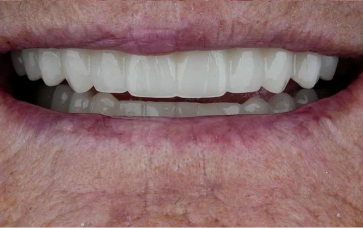 Sorriso com prótese protocolo